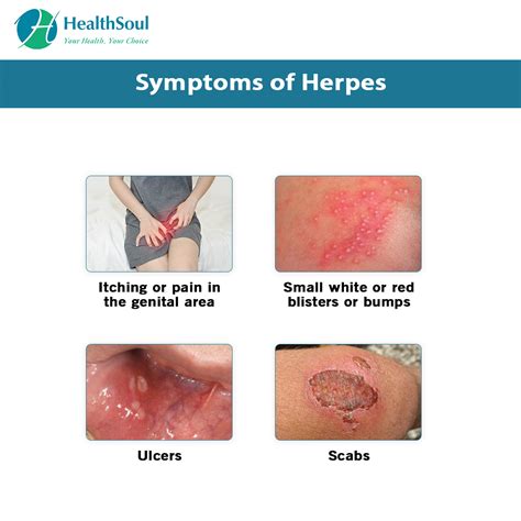 What you need to know about Herpes or HSV ? – Healthsoul