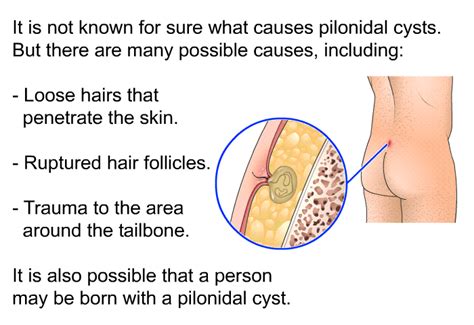 Pilonidal Cyst: What Is It, Causes, Treatment, And More, 53% OFF