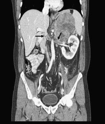 CT scan showing a mass, 15cm×10cm in diameter, of the left adrenal ...