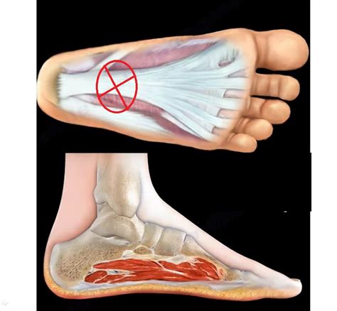 Rupture of the Plantar fascia — OrthopaedicPrinciples.com