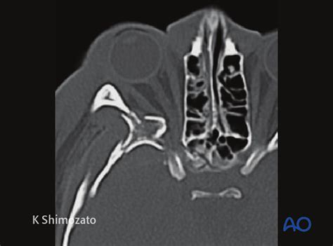 Orbital reconstruction for Orbit, orbital floor fracture