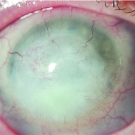 illustrates vascularization and scar formation of the cornea after the ...