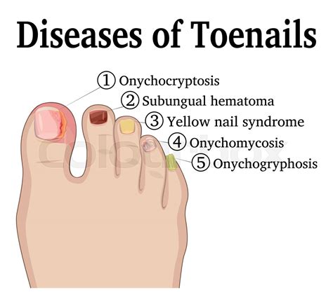 Diseases of Toenails | Stock vector | Colourbox