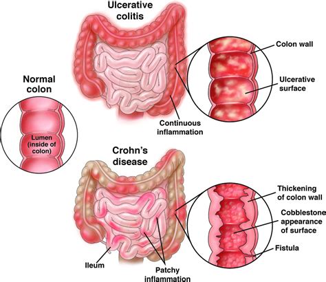 Crohns Disease