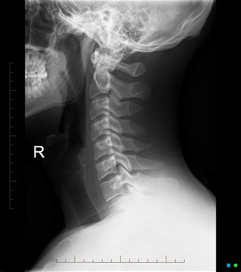 Healthy Cervical Spine Xray