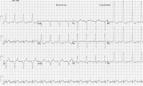 Pre-excitation syndromes • LITFL • ECG Library Diagnosis