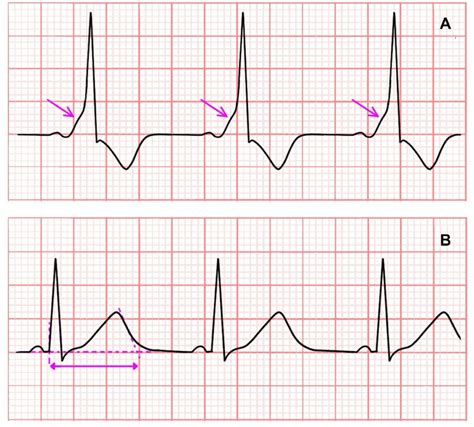 (A) Wolff-Parkinson-White (WPW) syndrome (pink arrow: Delta wave). (B ...