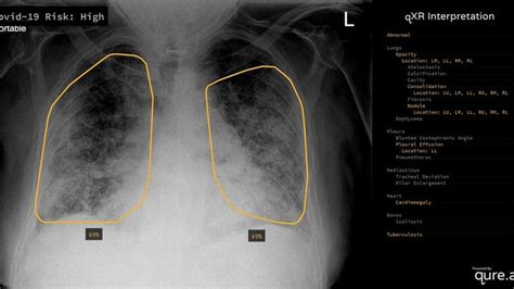 Pneumonia Healthy Lungs Xray - Goimages Urban