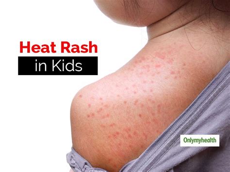 Heat Rash: Prickly Heat Rash Sweat Rash Pictures, Symptoms Treatment ...