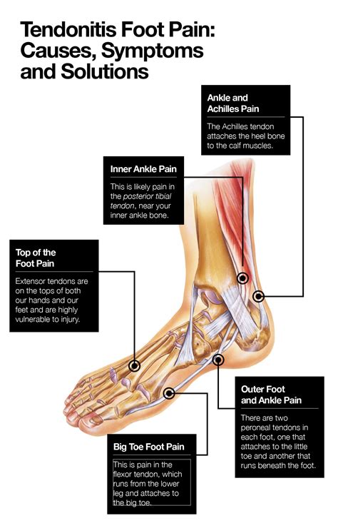 Tendonitis Foot Pain: Causes, Symptoms and Solutions – The Amino Company