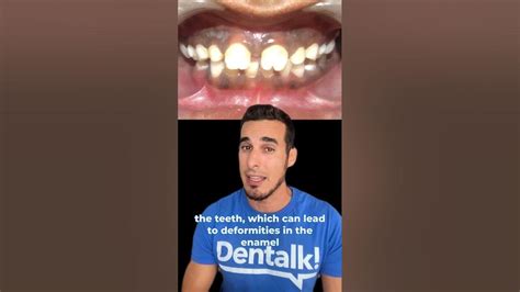 😲Incredible DENTAL MALFORMATION due to SYPHILIS - MULBERRY molars and ...