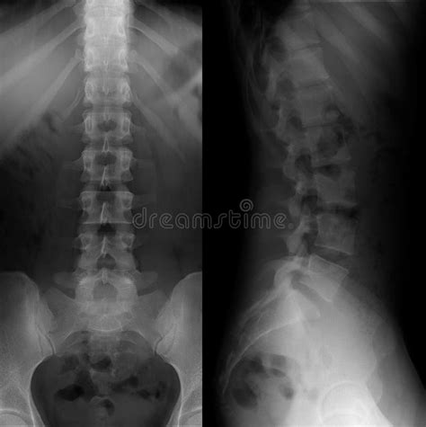 X-ray of the Lumbosacral Spine. Normal. Perfect Stock Photo - Image of ...