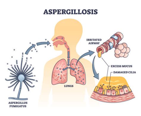 710+ Mold Allergy Stock Illustrations, Royalty-Free Vector Graphics ...