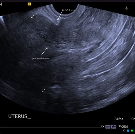 Placenta Accreta - Causes, Symptoms, Diagnosis, Risk Factors, Treatment