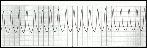 Float Nurse: Basic EKG Rhythm Test 06