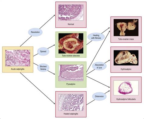 Fallopian Tube | Clinical Gate