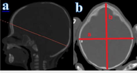 Cephalic index measurement a: cephalic index measurement plane in ...