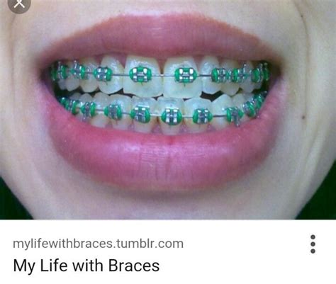 Green braces | Braces colors, Green braces, Getting braces