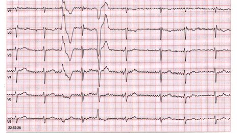 Ekg Practice Strips Printable