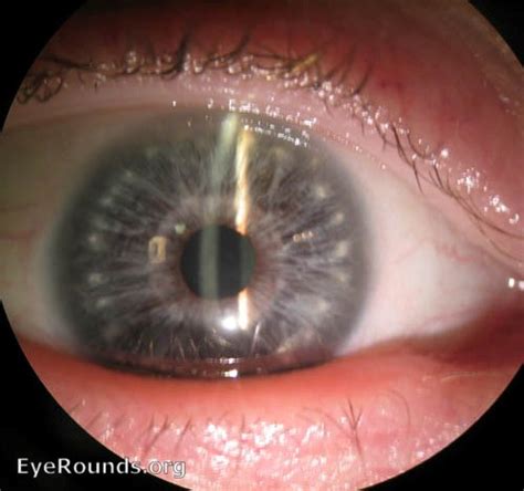 Atlas Entry - Down's Syndrome with Brushfield's spots on the iris