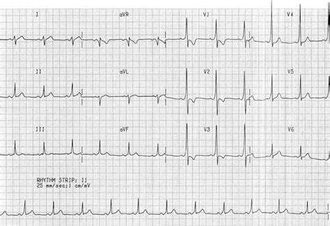 Pre-excitation syndromes • LITFL • ECG Library Diagnosis