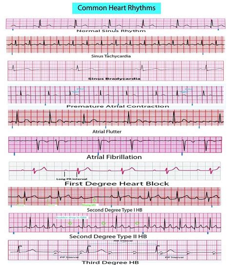 Printable Ekg Strips - Printable Word Searches