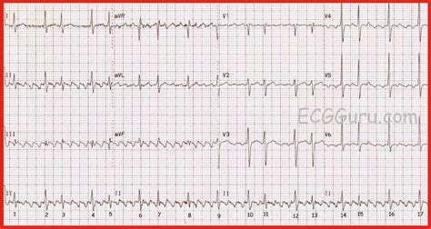 ECG Interpretation: ECG Blog #104 (My ECG Guru Comments-2) - AV Blocks ...