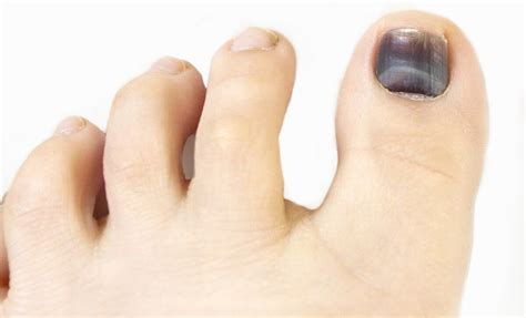 Toenail (Subungual Hematoma) vs. Melanoma: Visible Differences » Scary ...