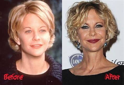 Meg Ryan Plastic Surgery Before and After | Plastic surgery, Celebrity ...