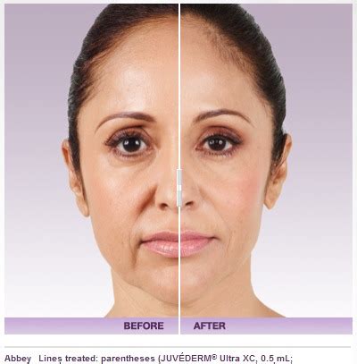 Juvederm Filler – Cost, Results, Risks, Side Effects | Beverly Hills