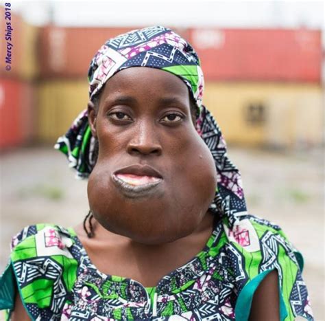 Lady Who Lived With A Disfigured Face For Nearly 10 Years Gets New Life ...