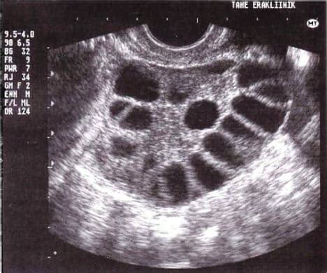 ¿Se puede diagnosticar el Síndrome de Ovario Poliquístico con una ...