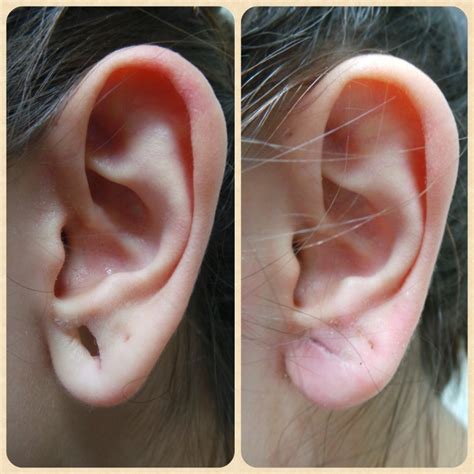 Ear Lobe Repair Surgery in Brisbane very experienced doctor