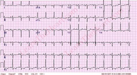 Left Ventricular Hypertrophy With Strain Pattern (Example 2) | Learn ...