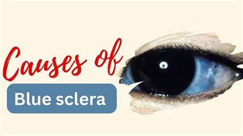 Blue Sclera: Causes and Mnemonics Explained! - YouTube