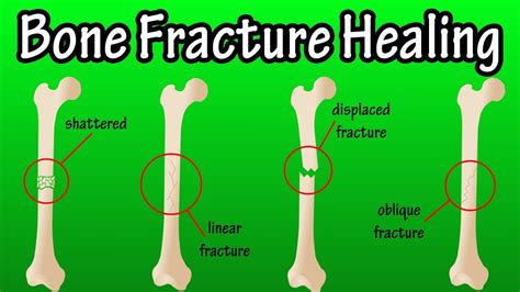 Nutrition For Fast Bone Healing | Besto Blog