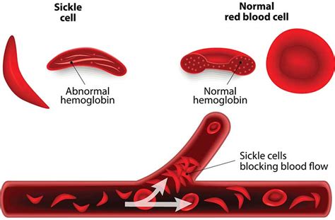 Types Of Sickle Cell Disease