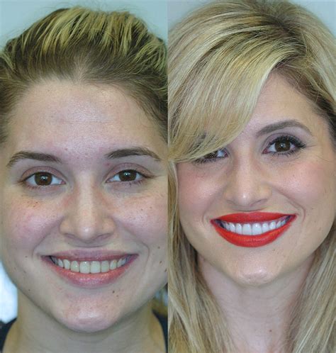 Before & After Porcelain Veneers - Cosmetic Dentists of Houston ...