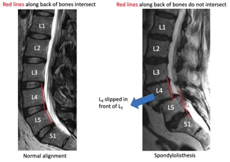 Lumbar Spine Mri Bulging Disc