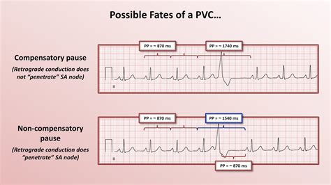 What Premature Ventricular Contraction (PVC) Looks Like On, 54% OFF