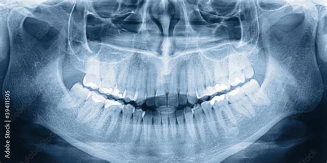 X-ray scan of teeth Stock Photo | Adobe Stock