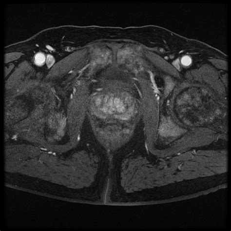 Prostate cancer MRI - wikidoc