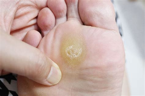 Calluses and Corns | Sutherland Podiatry Centre