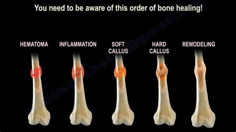 How Does Broken Bone Heal? - YouTube