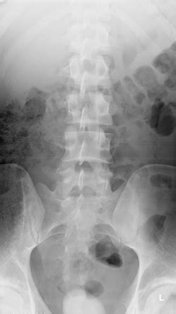 Lumbar Spine Xray Anatomy