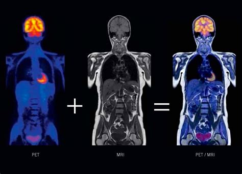 How do PET scans differ from MRI scans for neuroendocrine cancer ...