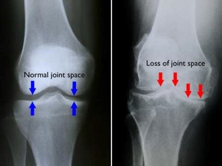 Arthritis of the Knee - OrthoInfo - AAOS