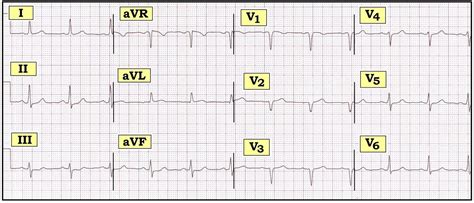 ECG Interpretation: ECG Interpretation Review #34 (Acute MI - vs ...