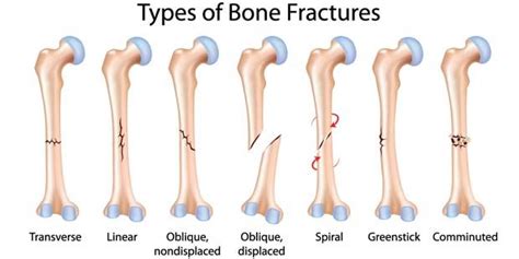 Singapore Bone Fractures Specialist Centre | Bone Clinic & Neurosurgeon