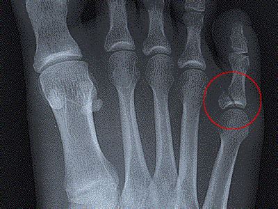 Broken Toe – Symptoms, Diagnosis, Treatment and Pictures